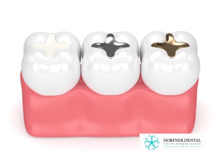 Detailed three-dimensional rendering presenting three teeth with different types of dental fillings, each distinct in color and material, providing a comprehensive view of treatment options.