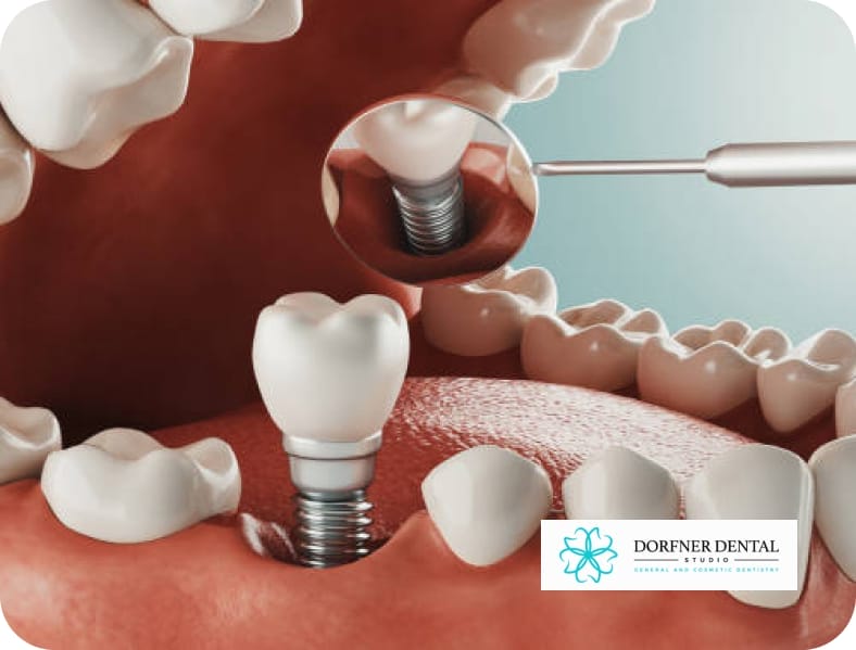 Dynamic three-dimensional visualization depicting the stages of a dental implant procedure, including initial assessment, implant placement, and final crown attachment, offering insight into the intricate process of restoring a missing tooth with precision and care.