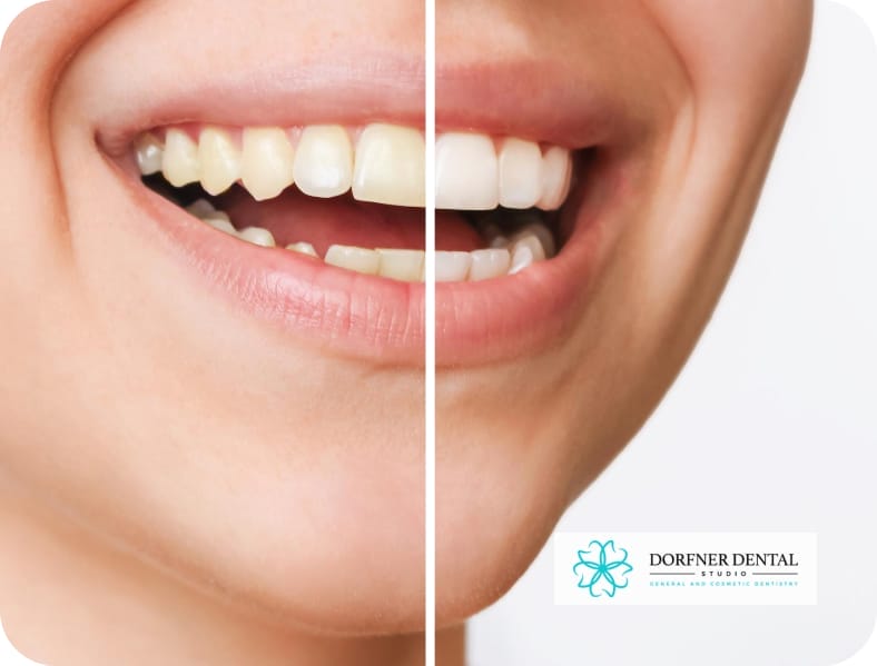 Side-by-side comparison photograph of teeth: one set in its natural color, the other after professional whitening treatment, illustrating the transformative effects.