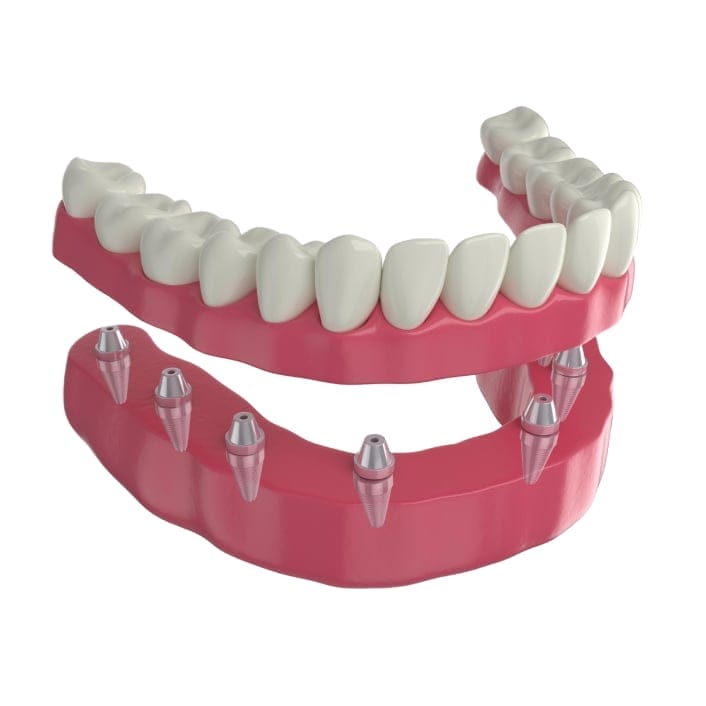 3D illustration of full-mouth dental implants for upper and lower jaw