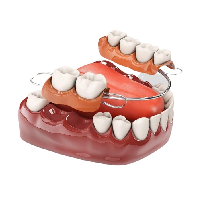 3D illustration of partial dentures with metal clasps on lower teeth