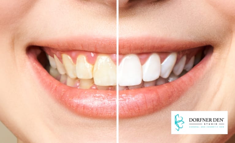 teeth comparison whitening before and after