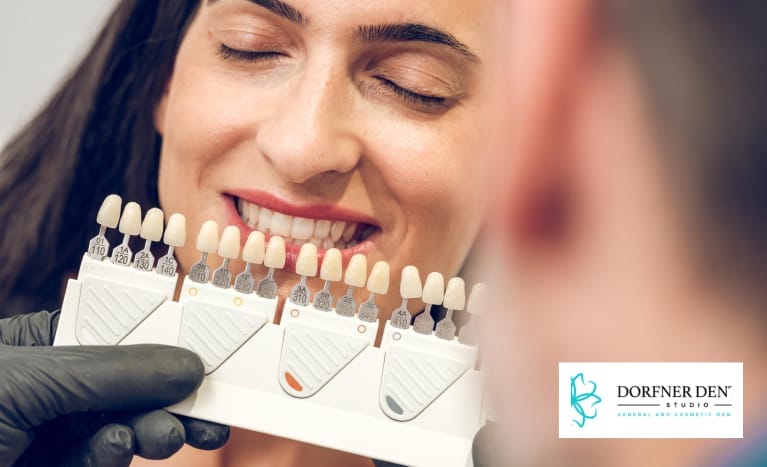 veneers