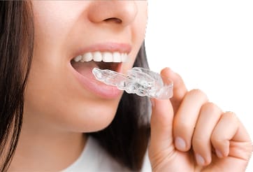 Invisalign Clear Aligner