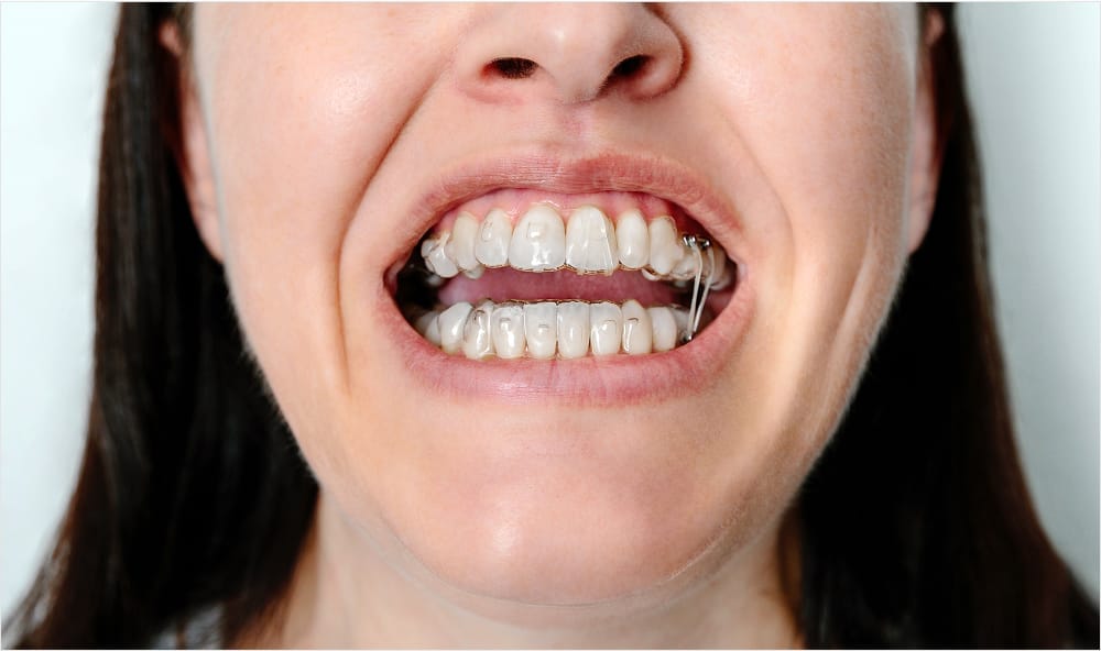 Close-up of a woman wearing Invisalign aligners, showing a full set of teeth