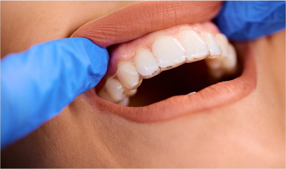 Gloved hand inserting Invisalign aligners onto teeth